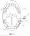 Fig. 02 - Actuator systems for oral-based appliances