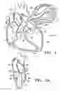 Fig. 02 - Device to permit offpump beating heart coronary bypass surgery