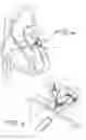 Fig. 06 - Closure device for left atrial appendage