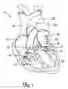 Fig. 02 - Expandable valve prosthesis with sealing mechanism