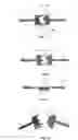 Fig. 04 - Two part hairline parting device