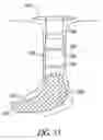 Fig. 22 - Lacrimal implants and related methods