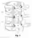 Fig. 02 - APPARATUS AND METHOD FOR CONNECTING SPINAL FIXATION SYSTEMS TOGETHER