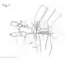 Fig. 02 - Method and Devices for Treating Damaged Articular Cartilage