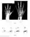 Fig. 02 - Method for skeletal maturity determination