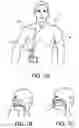 Fig. 02 - Systems, methods and apparatus for respiratory support of a patient