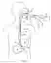 Fig. 02 - Detachable distal overtube section and methods for forming a sealable opening in the wall of an organ