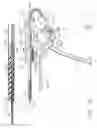 Fig. 34 - Method for deploying a device for gastric volume reduction