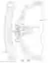 Fig. 56 - Method for deploying a device for gastric volume reduction