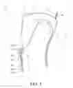 Fig. 03 - Orthopedic device having anteroposterior articulation