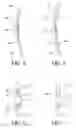 Fig. 05 - Orthopedic device having anteroposterior articulation