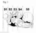 Fig. 02 - SLOW INTRAVENTRICULAR DELIVERY