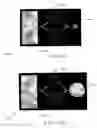 Fig. 12 - Fluidic adaptive lens systems with pumping systems