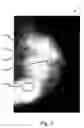 Fig. 04 - Voting in mammography processing