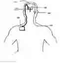 Fig. 01 - Method and apparatus for removing harmful proteins from a mammalian's ventricular cerebrospinal fluid
