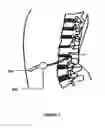 Fig. 03 - Method and apparatus for removing harmful proteins from a mammalian's ventricular cerebrospinal fluid