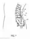 Fig. 05 - Devices and methods for delivering drug depots to a site beneath the skin