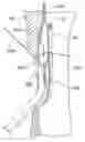 Fig. 01 - Systems and methods for transeptal cardiac procedures, including separable guidewires