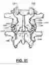Fig. 10 - Method and apparatus for spinal facet joint fusion using irregularly shaped cortical bone implants