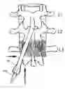 Fig. 01 - Stimulation/sensing lead adapted for percutaneous insertion