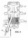 Fig. 03 - Stimulation/sensing lead adapted for percutaneous insertion