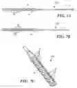 Fig. 04 - Stimulation/sensing lead adapted for percutaneous insertion