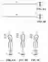 Fig. 05 - Stimulation/sensing lead adapted for percutaneous insertion