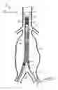 Fig. 02 - Delivery system and method for bifurcated graft