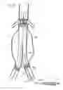 Fig. 22 - Delivery system and method for bifurcated graft