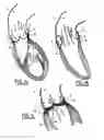Fig. 02 - Valve prosthesis for implantation in body channels