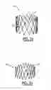 Fig. 03 - Valve prosthesis for implantation in body channels