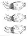 Fig. 19 - Valve prosthesis for implantation in body channels