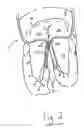 Fig. 04 - Apparatus and method for treating a regurgitant heart valve