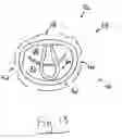 Fig. 09 - Apparatus and method for treating a regurgitant heart valve