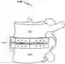 Fig. 01 - Artificial spinal disc replacement system and method