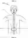 Fig. 04 - Artificial spinal disc replacement system and method