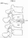 Fig. 07 - Artificial spinal disc replacement system and method