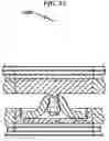 Fig. 33 - Artificial spinal disc replacement system and method