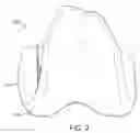 Fig. 04 - ARTHROPLASTY DEVICE