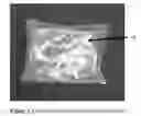 Fig. 04 - Breast compression for digital mammography, tomosynthesis and other modalities