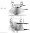 Fig. 08 - Measuring apparatus for the programming and welding of adjustable brackets