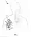 Fig. 02 - Use of a regenerative biofunctional collagen biomatrix for treating visceral or parietal defects