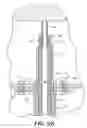 Fig. 09 - Transluminal endoscopic surgery kit