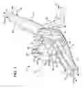 Fig. 02 - FLOW CONTROL DEVICE FOR PERITONEAL DIALYSIS
