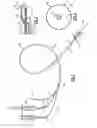 Fig. 02 - BALLOON CATHETER WITH SAFETY FEATURE