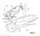 Fig. 07 - Methods, Devices, Kits and Systems for Defunctionalizing the Gallbladder