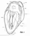 Fig. 02 - Devices, systems, and methods for closing the left atrial appendage