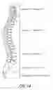 Fig. 02 - Method and apparatus for manipulating material in the spine