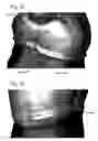 Fig. 33 - DESIGN OF DENTAL APPLIANCES