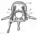 Fig. 01 - Guide pin for pedicle screw placement and method for use of such guide pin in spinal fusion surgeries